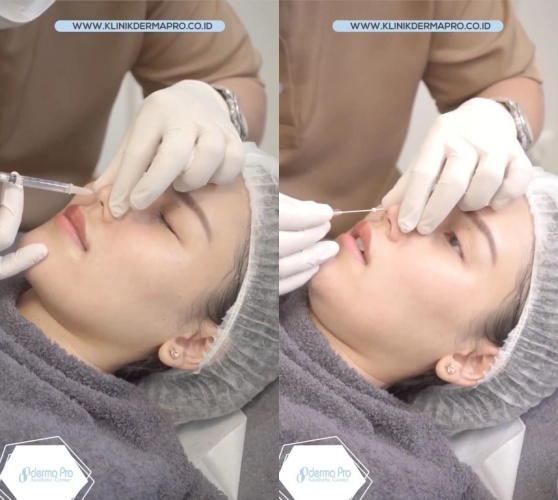 Ayu Ting Ting tanam benang © Instagram Ayu Ting Ting tanam benang © Instagram