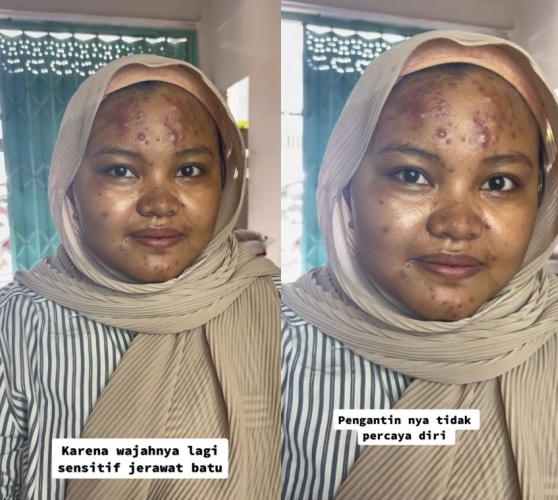 wanita jerawat batu dirias MUA © TikTok