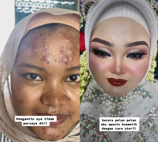 wanita jerawat batu dirias MUA © TikTok