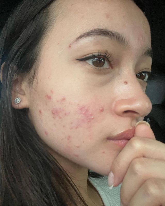 Kisah Megan Domani selama berjerawat © 2023 brilio.net