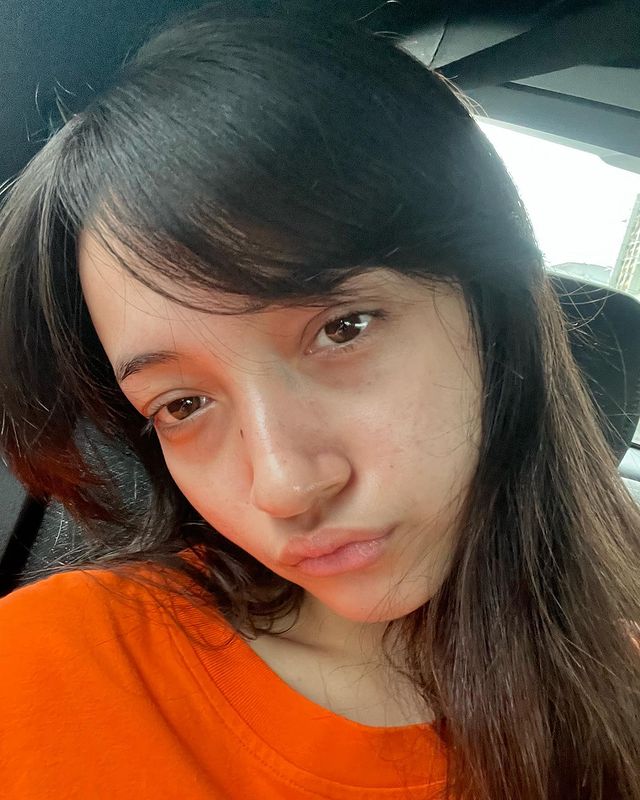 Kisah Megan Domani selama berjerawat © 2023 brilio.net