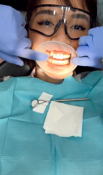 penampilan gigi baru Chelsea Olivia © 2023 brilio.net