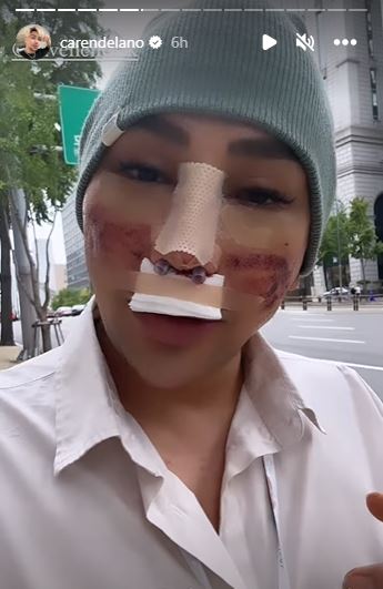 7 Momen Caren Delano jalani operasi hidung di Korea, tetap pede jalan-jalan meski wajah bengkak