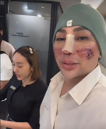 Momen Caren Delano jalani operasi hidung di Korea © 2023 brilio.net