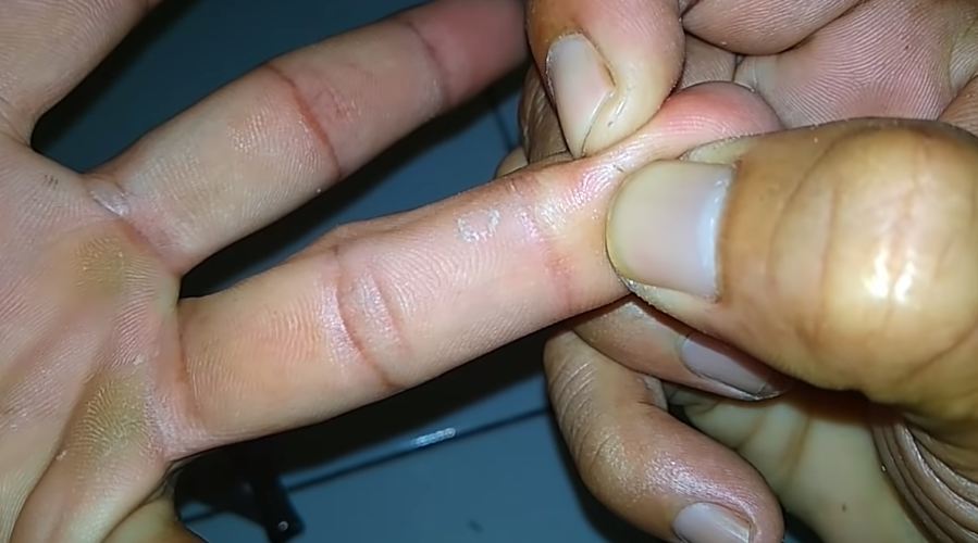 Tanpa jarum atau larutan garam, ini trik ampuh mengeluarkan duri di tangan cuma pakai 1 jenis buah