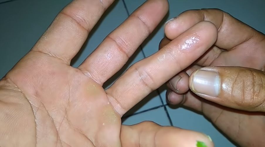 Tanpa jarum atau larutan garam, ini trik ampuh mengeluarkan duri di tangan cuma pakai 1 jenis buah