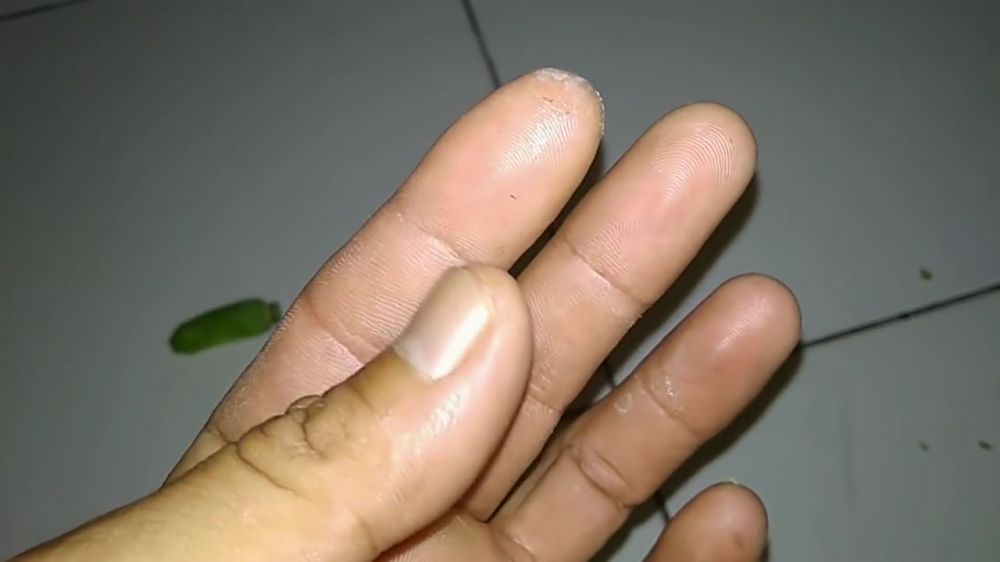 Tanpa jarum atau larutan garam, ini trik ampuh mengeluarkan duri di tangan cuma pakai 1 jenis buah