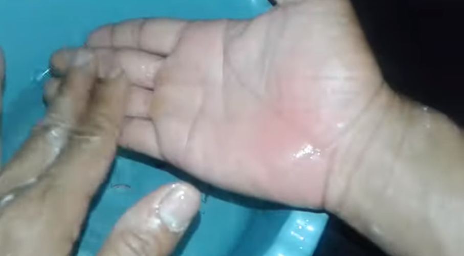 Bukan dioles pasta gigi, ini trik agar tangan tak melepuh usai terkena air panas cuma pakai 1 bahan