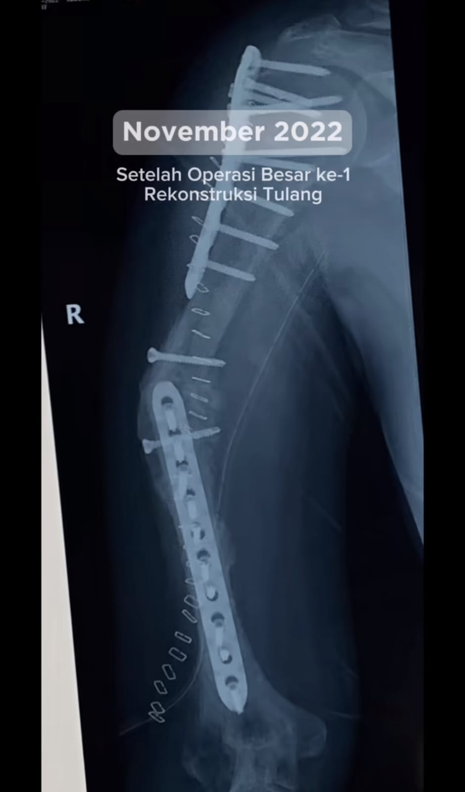 cerita kanker tulang. © TikTok