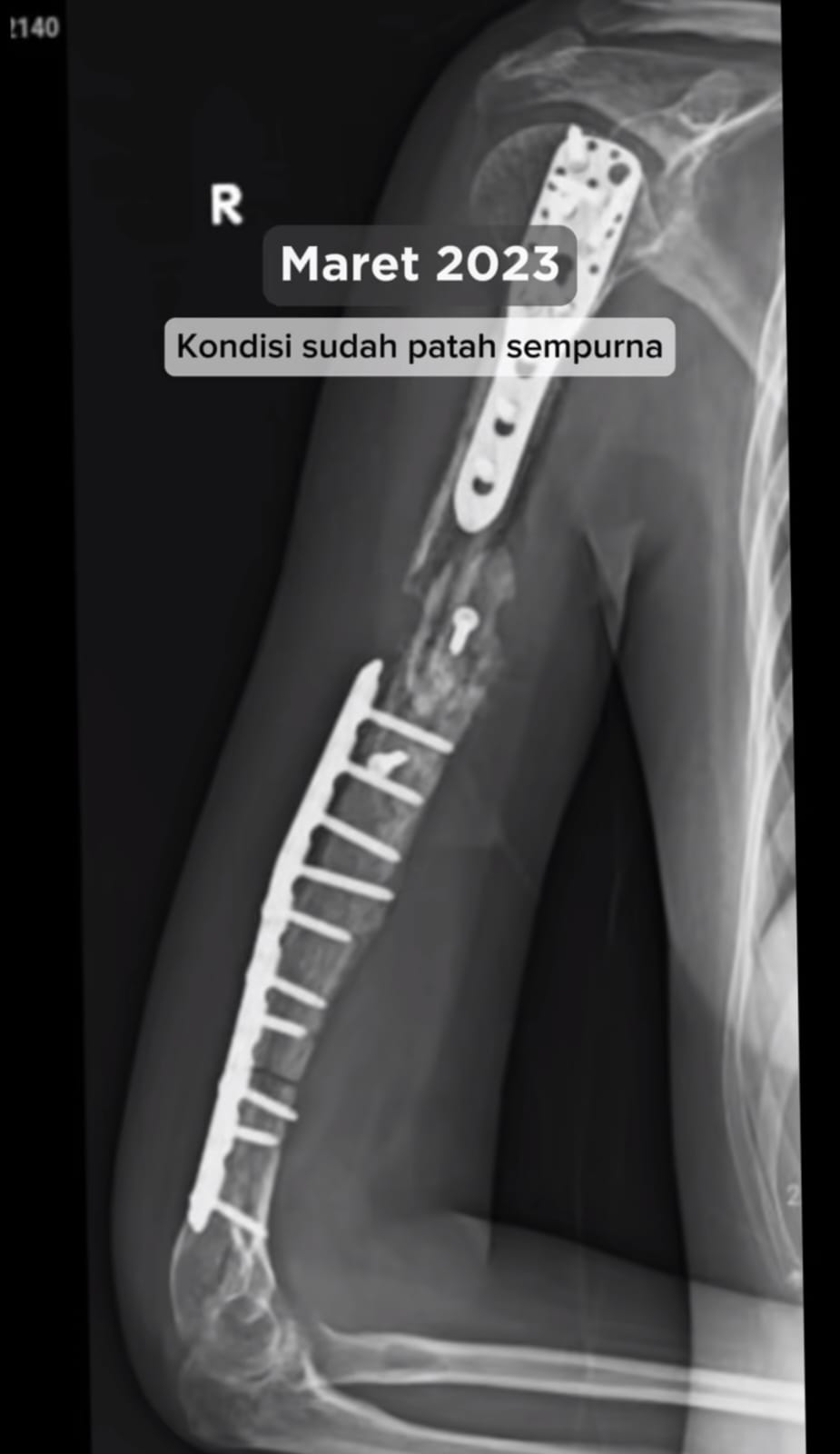 cerita kanker tulang. © TikTok