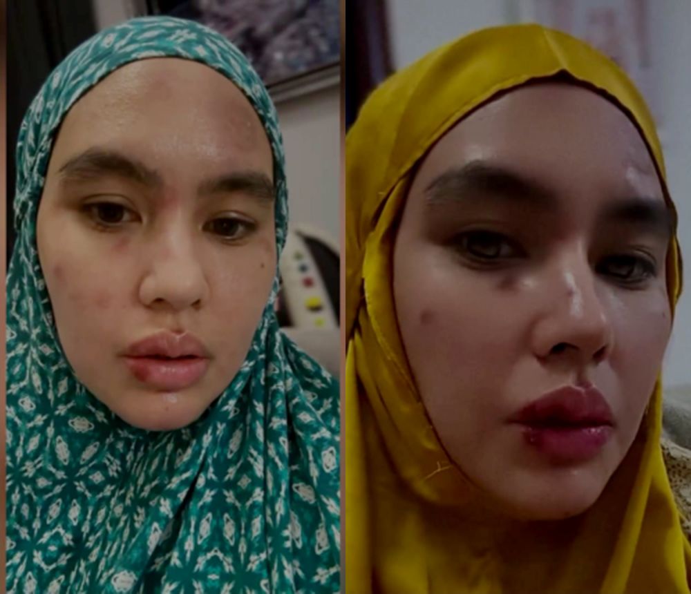 Muka melepuh kini mulus dan kinclong, ini 11 potret transformasi wajah Kartika Putri usai pengobatan