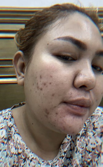 Mira Hayati sebelum perawatan © TikTok