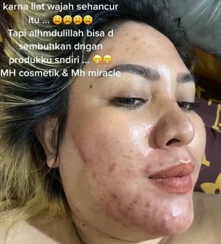 Mira Hayati sebelum perawatan © TikTok