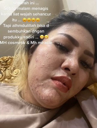 Mira Hayati sebelum perawatan © TikTok