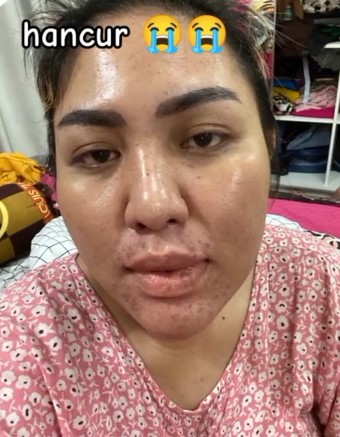Mira Hayati sebelum perawatan © TikTok