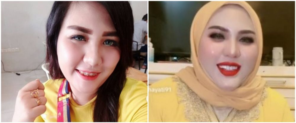 Mira Hayati sebelum sesudah behel © Instagram Mira Hayati sebelum sesudah behel © Instagram