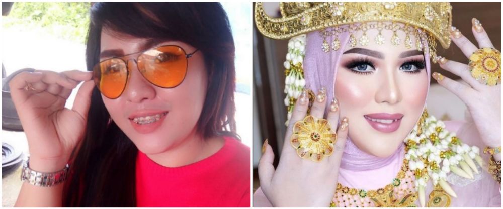 Mira Hayati sebelum sesudah behel © Instagram Mira Hayati sebelum sesudah behel © Instagram