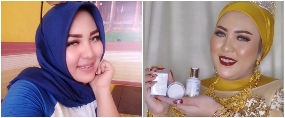 Mira Hayati sebelum sesudah behel © Instagram Mira Hayati sebelum sesudah behel © Instagram