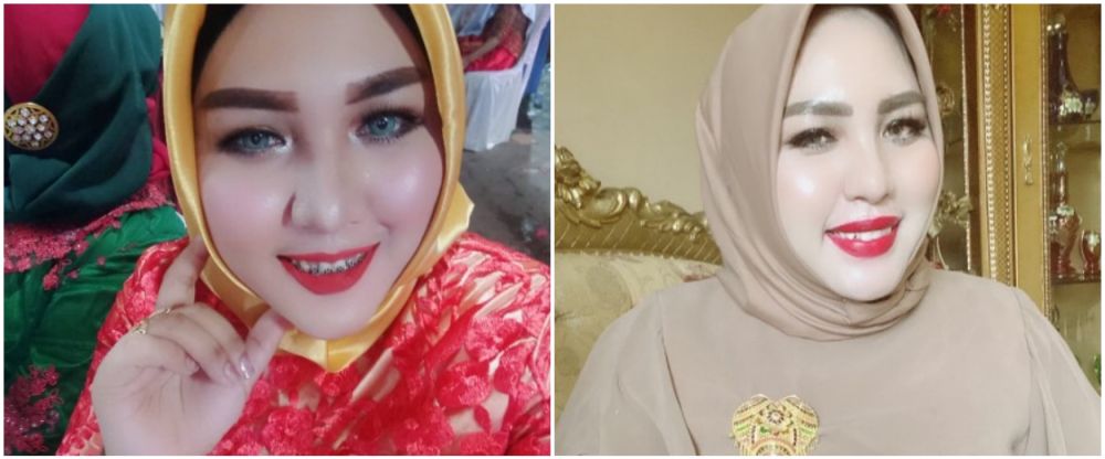 Mira Hayati sebelum sesudah behel © Instagram Mira Hayati sebelum sesudah behel © Instagram