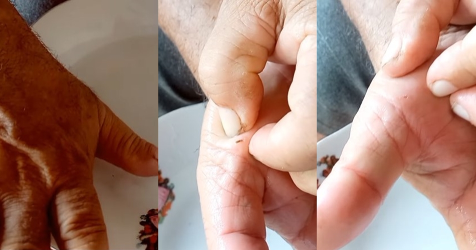 Bukan diambil dengan jarum, ini trik atasi kulit kesusupan cukup andalkan 1 bumbu dapur