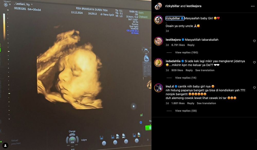 Hidung anak kedua Rizky Billar bikin salfok © 2024 Instagram