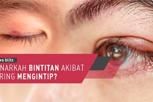 Benarkah bintitan akibat sering mengintip?