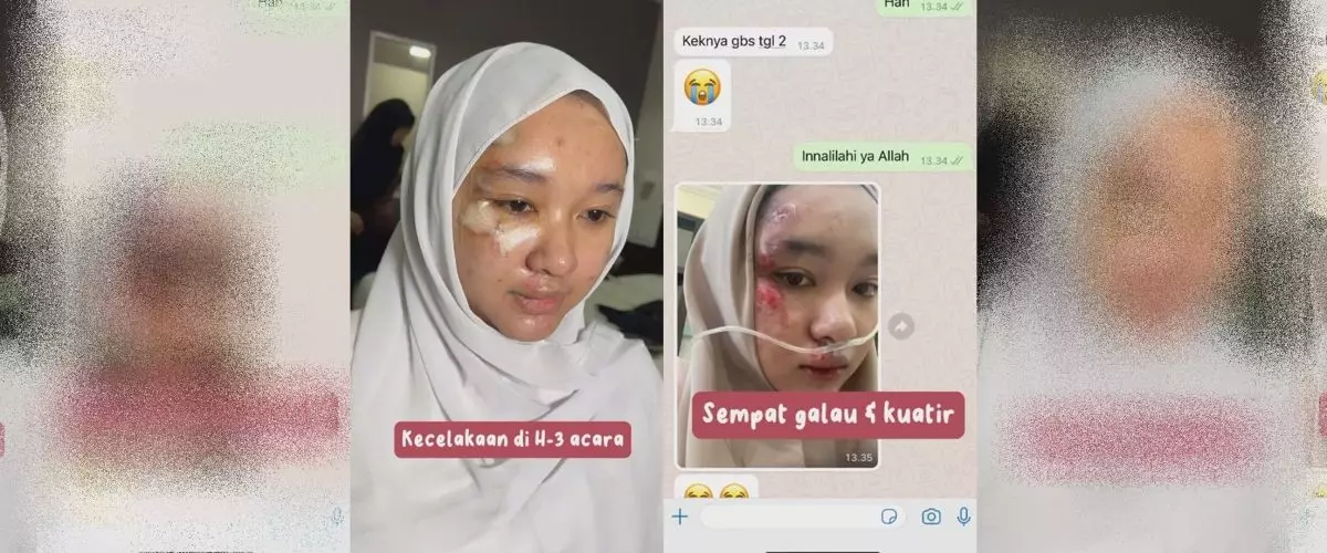 Alami kecelakaan H-3 menikah, pengantin dimakeup MUA ini tetap manglingi meski wajah penuh lecet