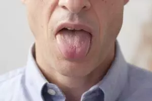 Kenali kesehatanmu lewat warna lidah 