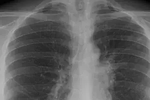 Waspada, TBC akan bunuh 75 juta orang pada 2050