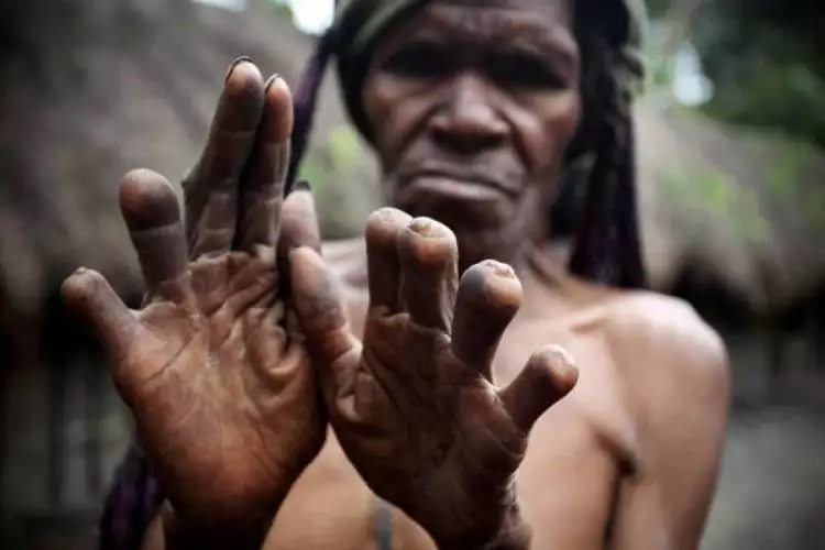 Kehilangan jari tangan, bukti kesetiaan cinta wanita Suku Dani