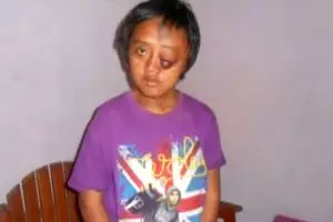 VIDEO: Mengharukan, perjuangan kisah pemuda alami tumor di kaki & mata