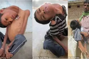 Malangnya nasib Mahendra, berpenyakit langka kepalanya menggantung