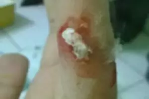 Terinspirasi pengobatan cara lama, sarang laba-laba jadi plester luka