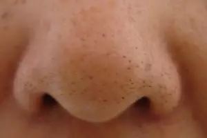 Kamu komedoan? Ini cara murah dan alamiah menghilangkannya