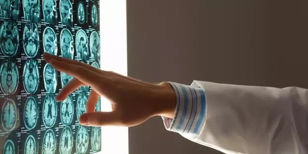 Kamu sering gemetaran? Hati-hati mungkin itu gejala Multiple Sclerosis