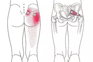 Stop kebiasaan menaruh dompet di saku belakang, ini bahayanya!