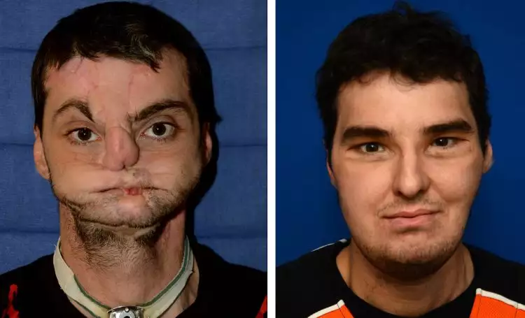 Pria ini menerima wajah baru melalui transplantasi wajah, mengharukan!