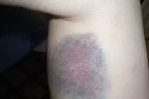 Kulit kamu tiba-tiba memar berwarna biru? Jangan panik, ini sebabnya