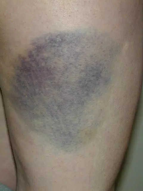 Kulit kamu tiba-tiba memar berwarna biru? Jangan panik, ini sebabnya