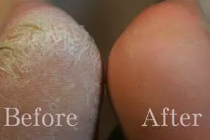 5 Cara ampuh usir tumit pecah-pecah