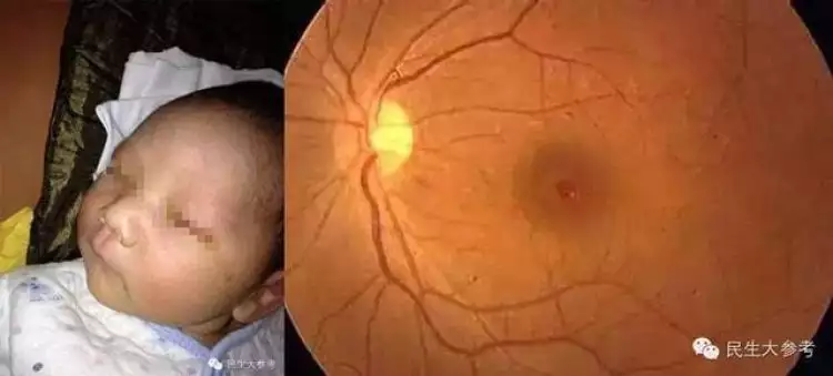 Dokter mata Amerika: Lampu kamera bukan penyebab bayi di China buta