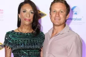 Kisah Turia Pitt, dapatkan cinta sejati meski fisiknya berubah jelek