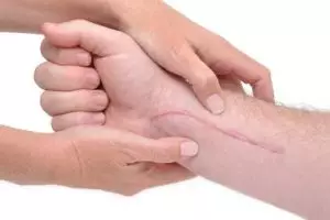 Cara menghilangkan bekas luka pada tubuh