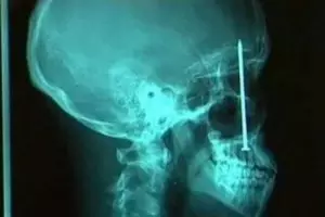 10 Benda yang ditemukan dalam tubuh manusia, bikin merinding ya?