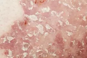 Mengenal penyakit psoriasis, pasiennya berisiko mengalami depresi