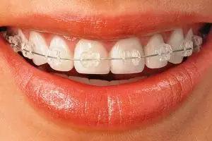 9 Hal ini cuma dirasakan cewek yang memakai behel, semangat ya cantik!