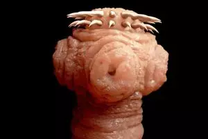 Kerap sakit kepala, ternyata cacing pita bersarang di otak wanita ini