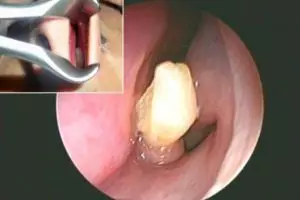 Sering mimisan, ada gigi yang tumbuh di hidung pria ini