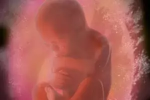 Ngeri, ada janin mati di perut bocah empat tahun