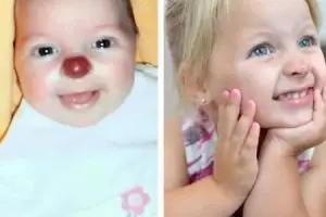 Kumpulan tanda lahir paling aneh, bikin nggak tega melihatnya